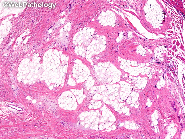Soft Tissue_Lipomatous_Lipoblastoma7.jpg